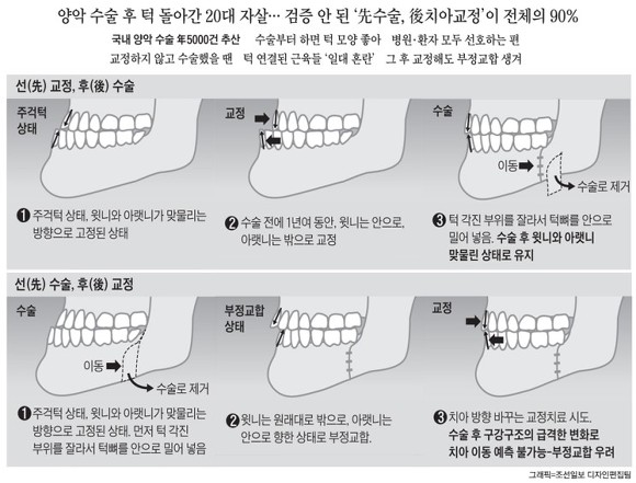 턱수술과 양악수술의 차이.gif | 인스티즈