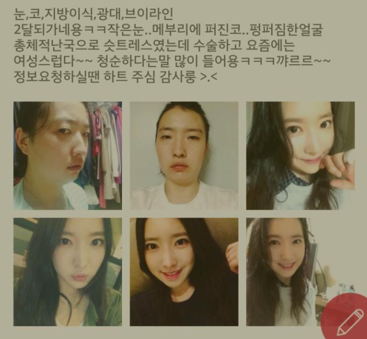 여자들 성형수술 후기.jpg | 인스티즈