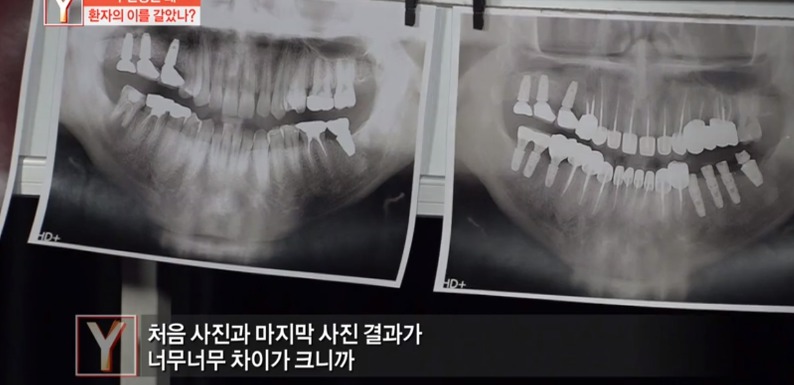 [궁금한이야기] 같은 치과 의사들도 충격받았다는 진료사진.jpg | 인스티즈