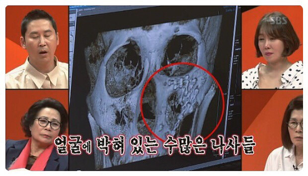 이상민 얼굴에 박혀있는 수많은 나사 | 인스티즈